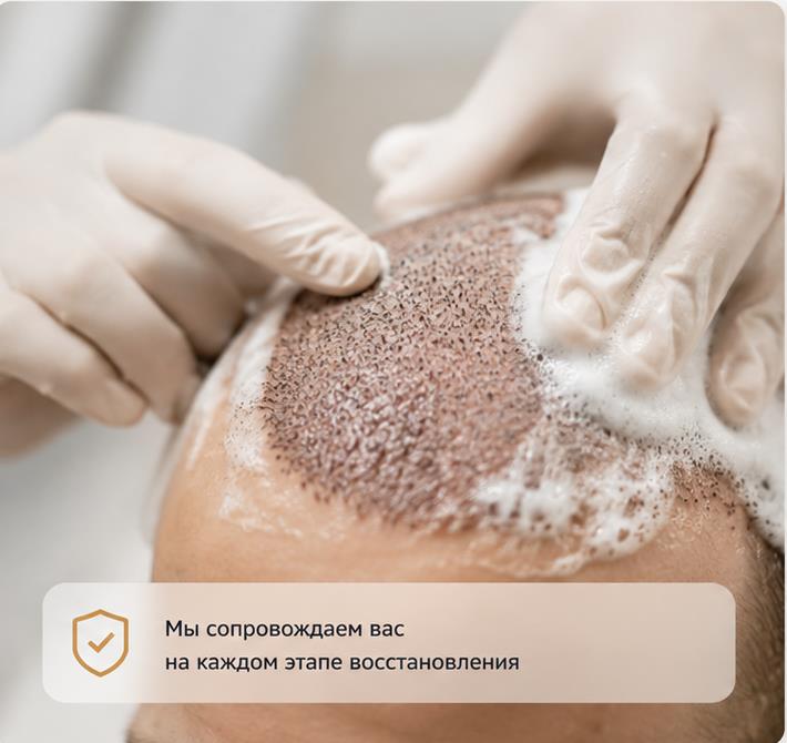 Что такое FUE и как проходит пересадка волос